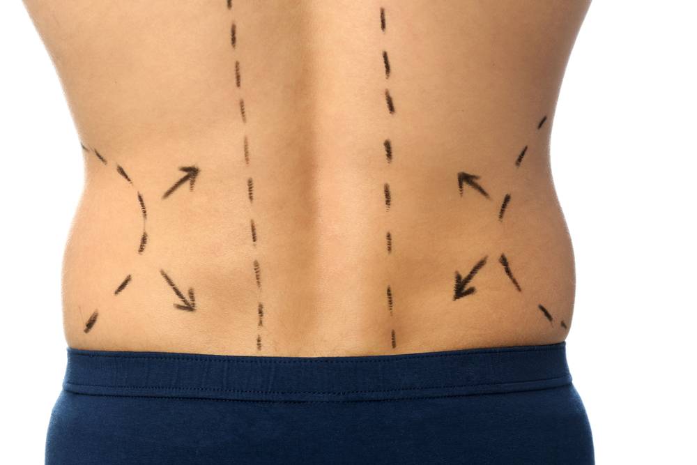 Will Fat Move Elsewhere After Liposuction Cosmetic Surgery? Dr Frati Cosmetic Surgery