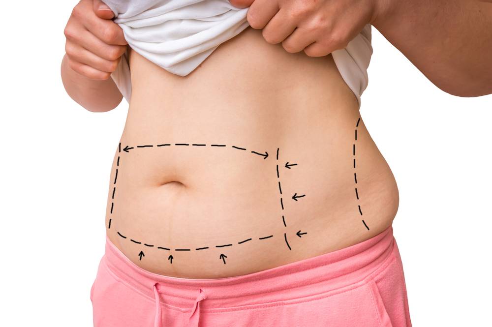 The Difference Between a Tummy Tuck and Liposuction Dr Frati Cosmetic Surgery