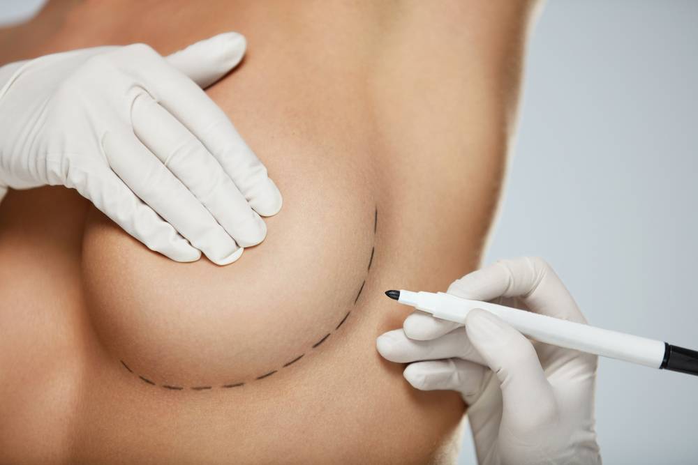 What to Expect After a Breast Augmentation Dr Frati Cosmetic Surgery