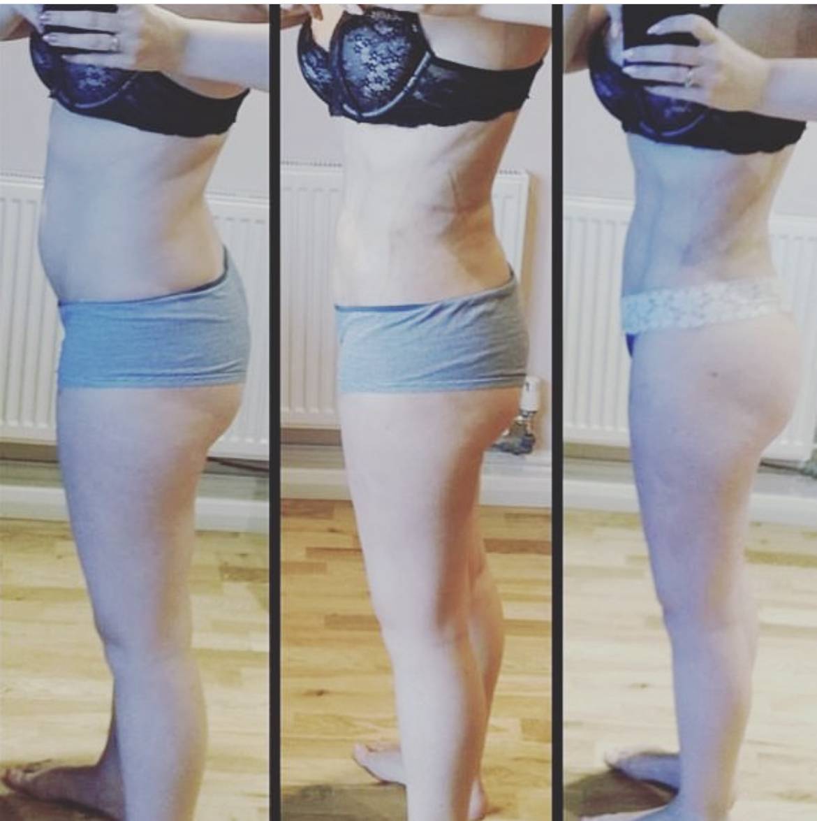tummy tuck before and after three photos