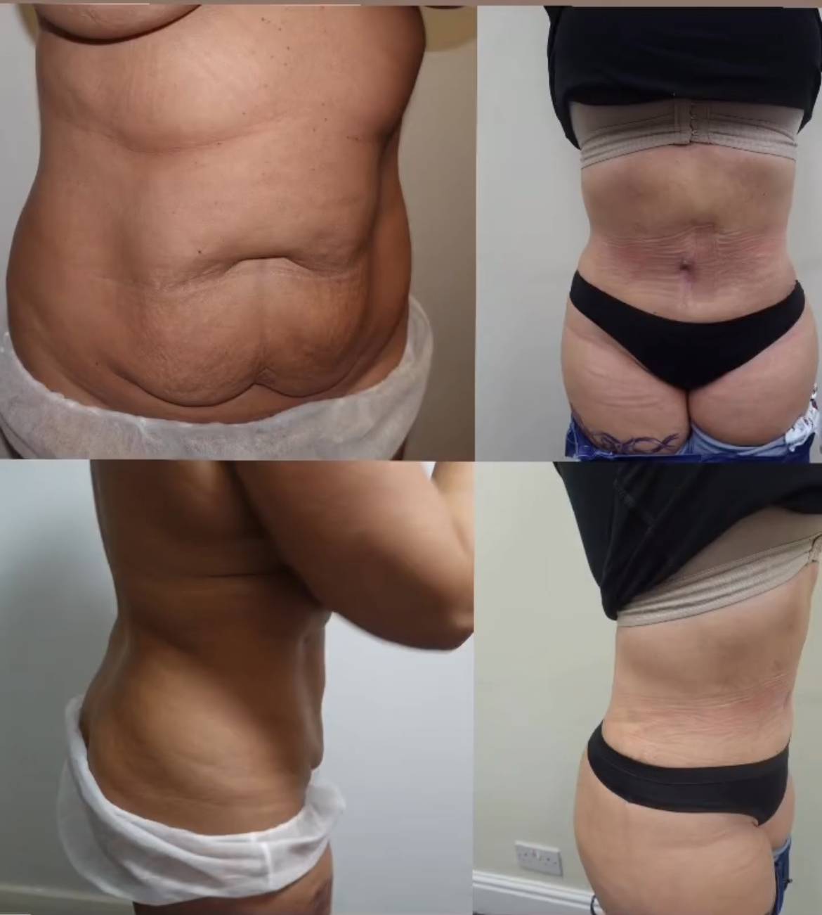 a dr Frati tummy tuck before and after