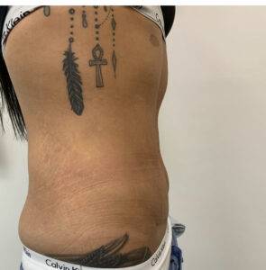 tummy tuck before and after by Frati