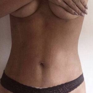 tummy tuck