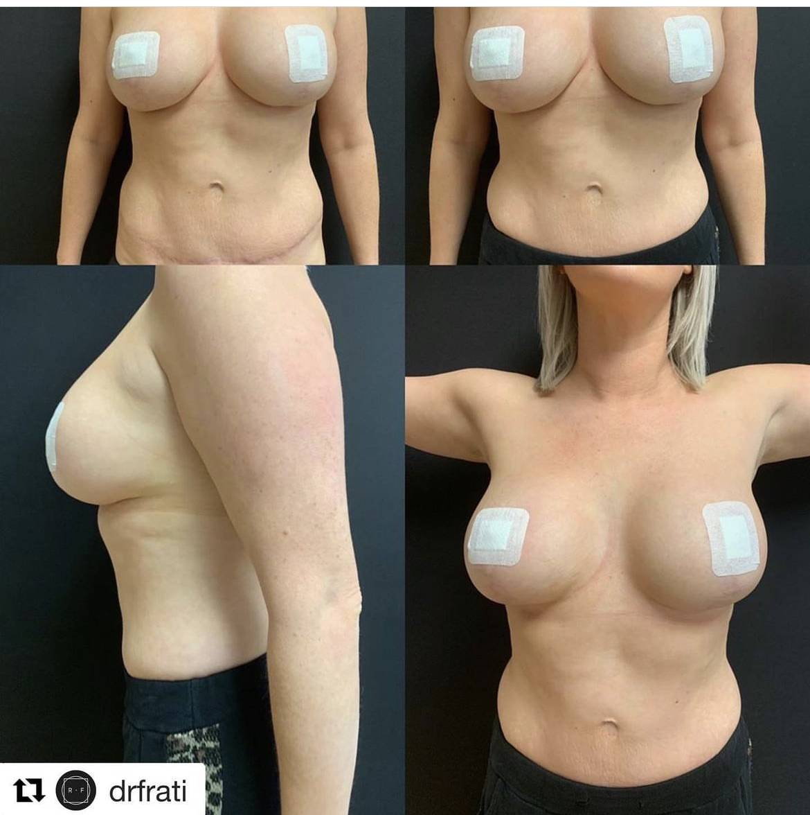 What’s the Difference Between Tummy Tuck and Liposuction?  Complete Guide by Dr Frati