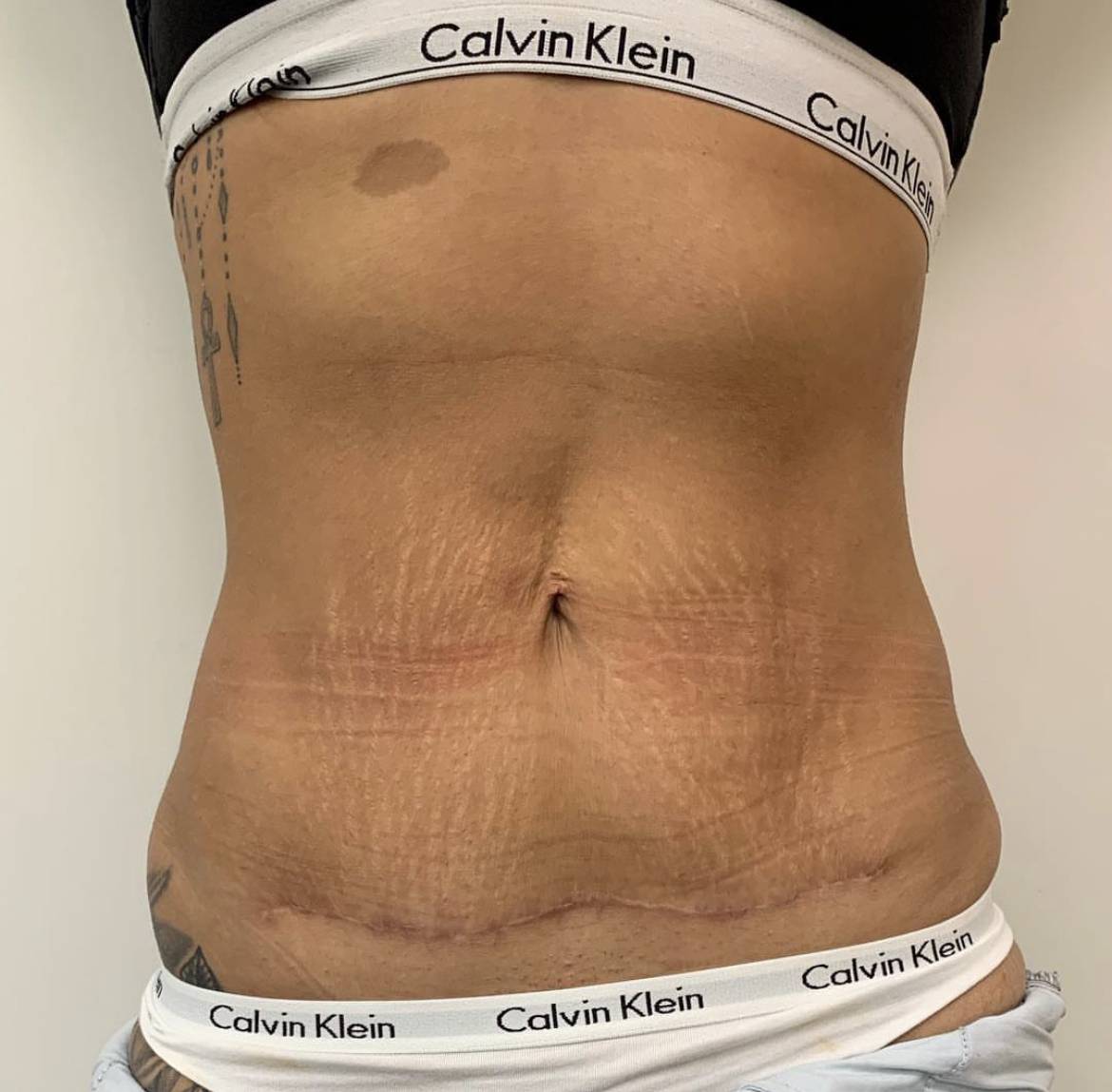 tummy tuck before and after by dr Frati