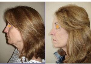 facelift before an after images