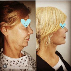 images of a facelift before and after