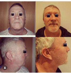 a man with a before and after of a facelift