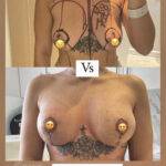 boob job before and after image by Riccardo Frati