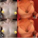 breast augmentation London pictures when finished and before