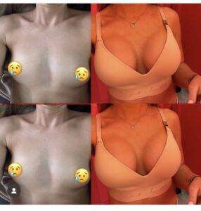 breast augmentation London pictures when finished and before