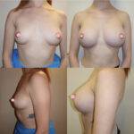 breast augmentation London results