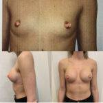 breast augmentation London reveal