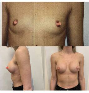 breast augmentation London reveal
