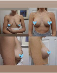 small to large breast lift before and after