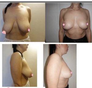breast lift before and after new images