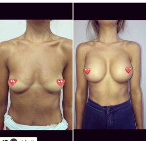 breast lift before and after and also implants