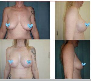 breast lift before and after on a woman 4 images