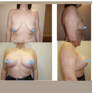 breast lift before and after on our latest patient