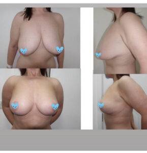 4 images of breast lift before and after on one of our patient