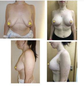 breast lift before and after 4 images