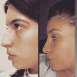 nose job before and after on a woman by dr frati