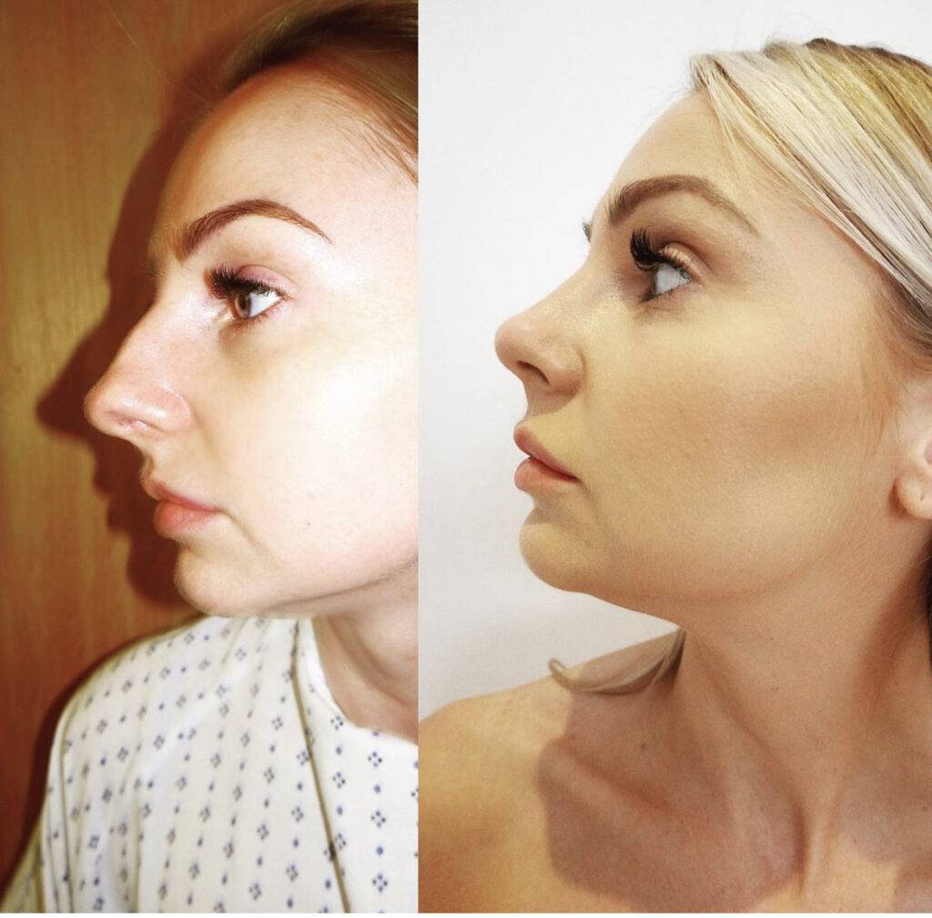 Dr frati nose job before and after on a young woman
