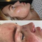 nose job before and after post operation on a woman
