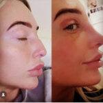 Rhinoplasty nose job before and after a bulbous nose rhinoplasty