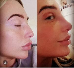 Rhinoplasty nose job before and after a bulbous nose rhinoplasty
