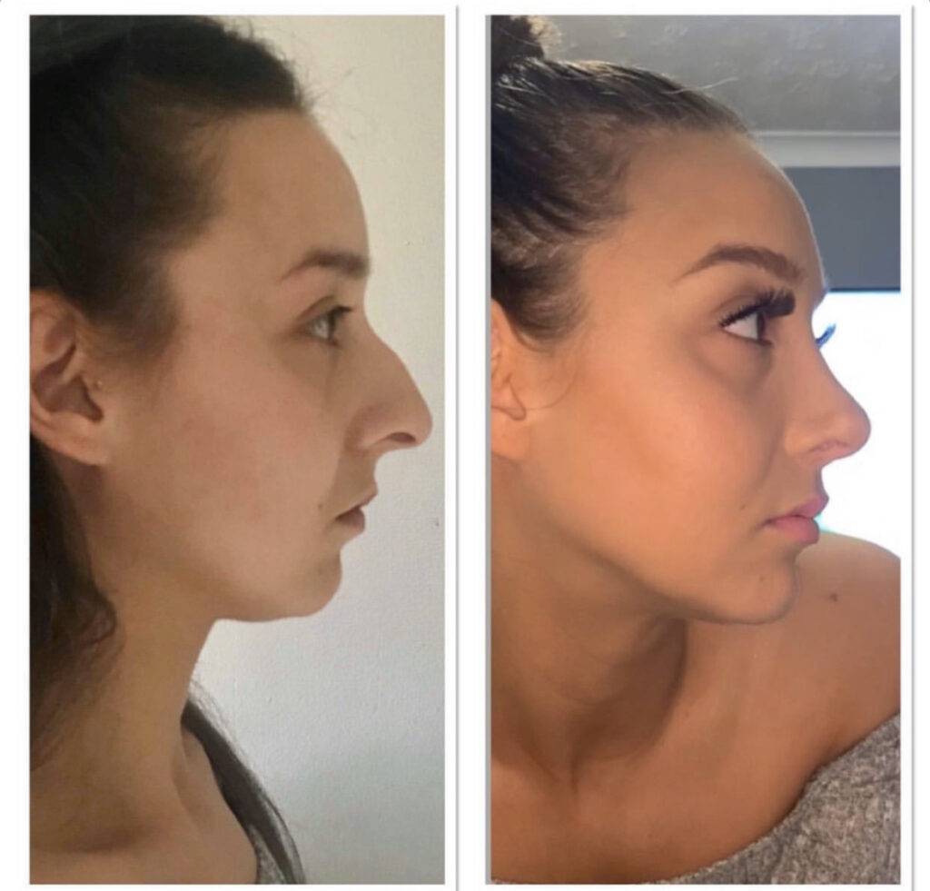 a woman demonstrating a nose job before and after