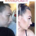 closed rhinoplasty nose job before and after