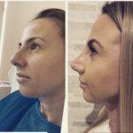 nose job before and after by Dr Frati rhinoplasty in Manchester