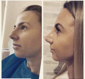 nose job before and after by Dr Frati rhinoplasty in Manchester