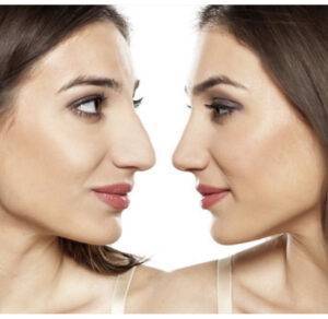asian rhinoplasty cost Manchester nose job manchester from the best rhinoplasty surgeon uk
