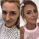 young lady showing a nose job before and after