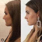 nose job before and after on a woman with a large earring