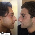 celebrity nose job before and after non surgical rhinoplasty by the best rhinoplasty surgeon London