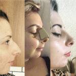 3 photos of a nose job before and after