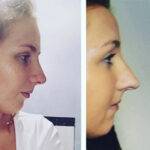 nose job before and after on a young lady