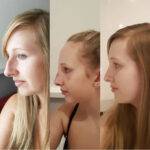 a young woman of her nose job before and after 3 images