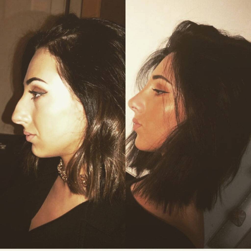 nose job before and after on a woman with dark hair