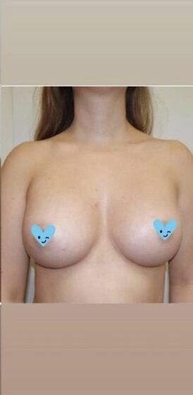 costo dell'intervento di mastoplastica additiva prima e dopo il trasferimento di grasso